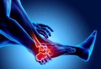 Foot Joint Deformities in Rheumatoid Arthritis