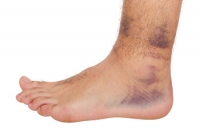 Recovering From an Ankle Sprain